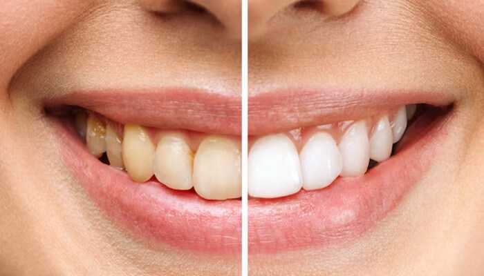 Marketing tips for dental practices to promote teeth whitening products