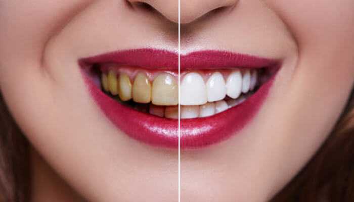 Revolutionary advances in teeth whitening